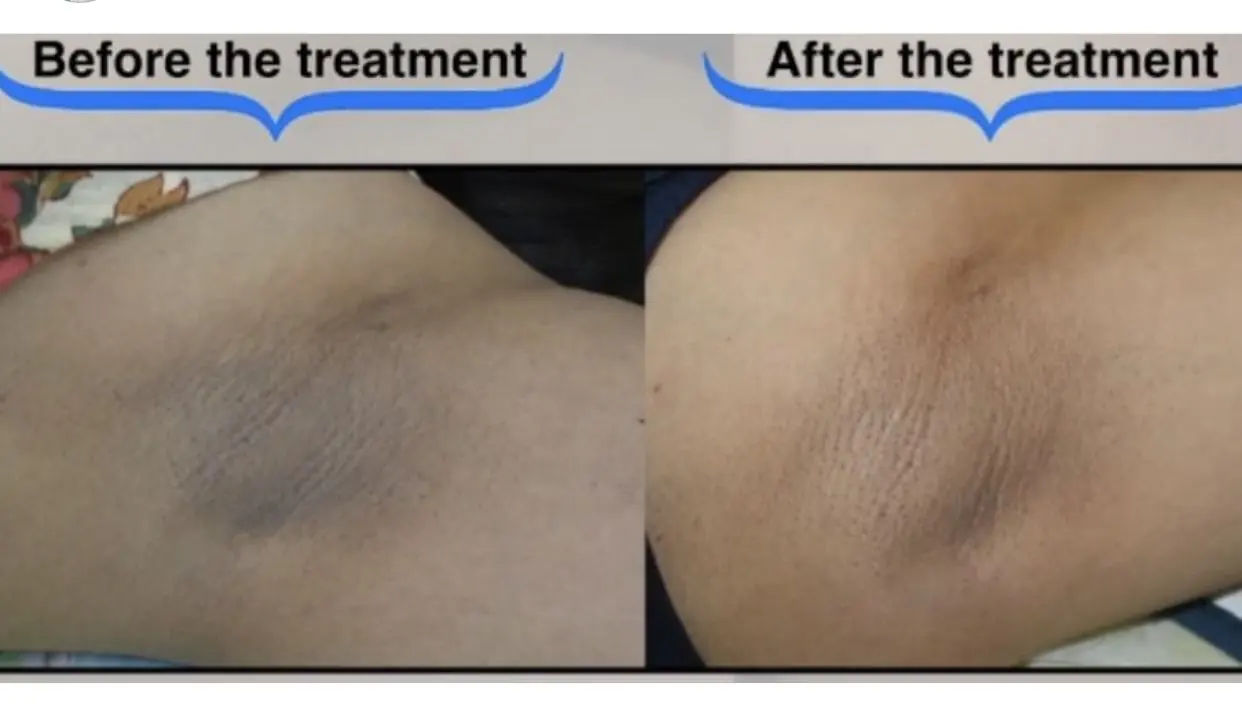 Avant / après traitement de la cellulite – Dr Siham Bennis Marrakech