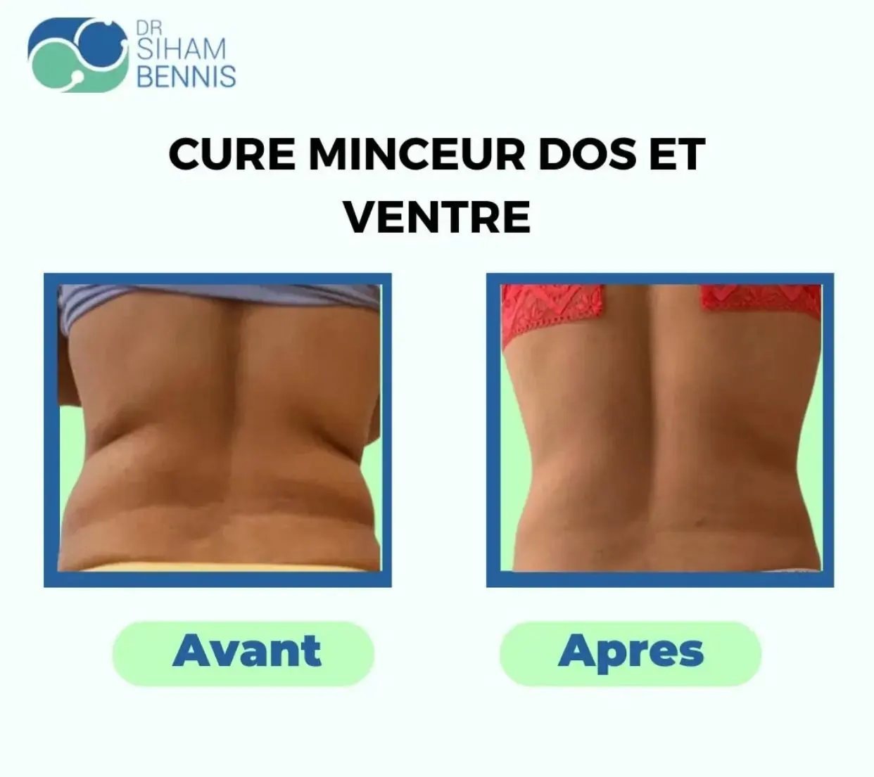 Avant / après cure minceur dos et ventre – Marrakech