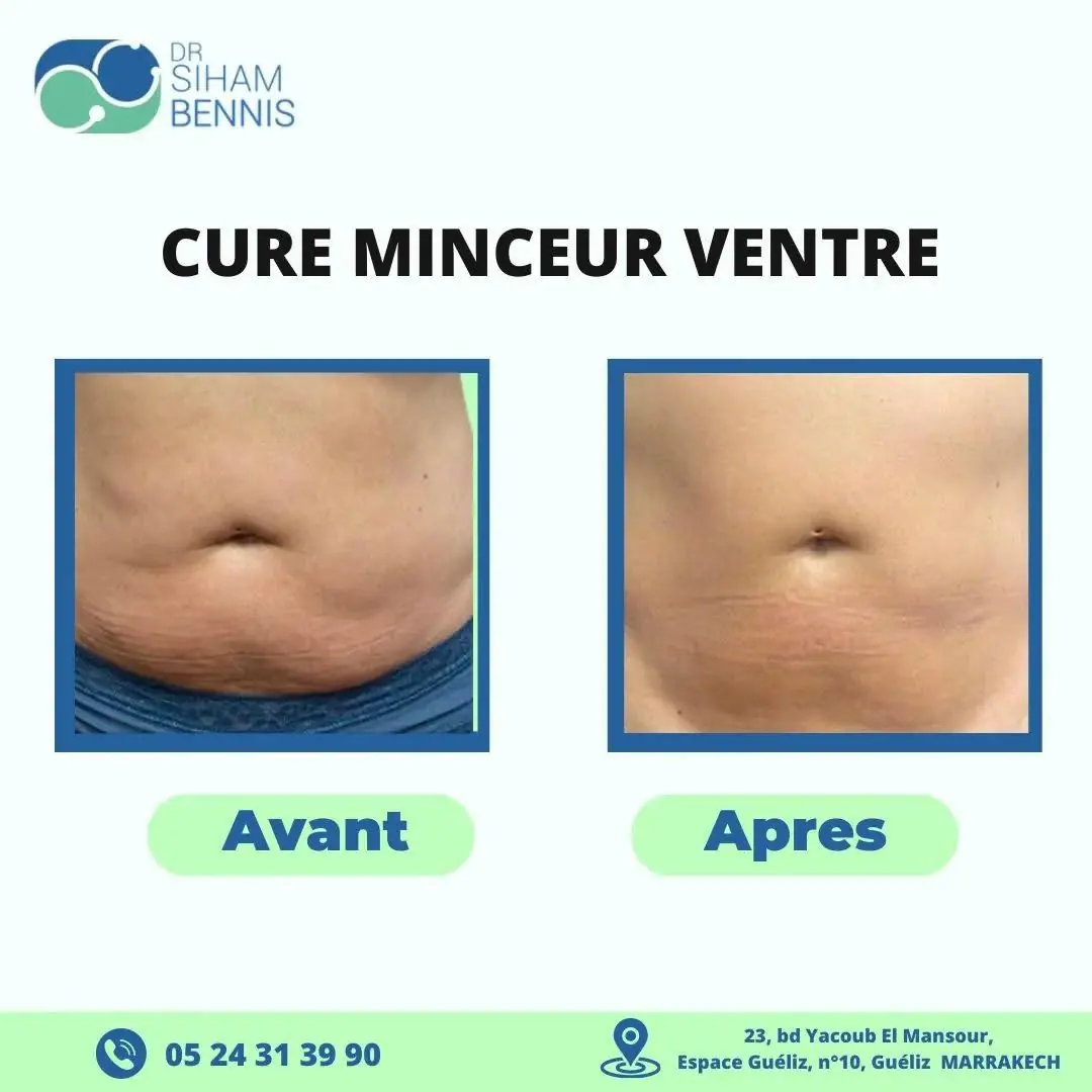 Avant / après cure minceur ventre – Dr Siham Bennis Marrakech