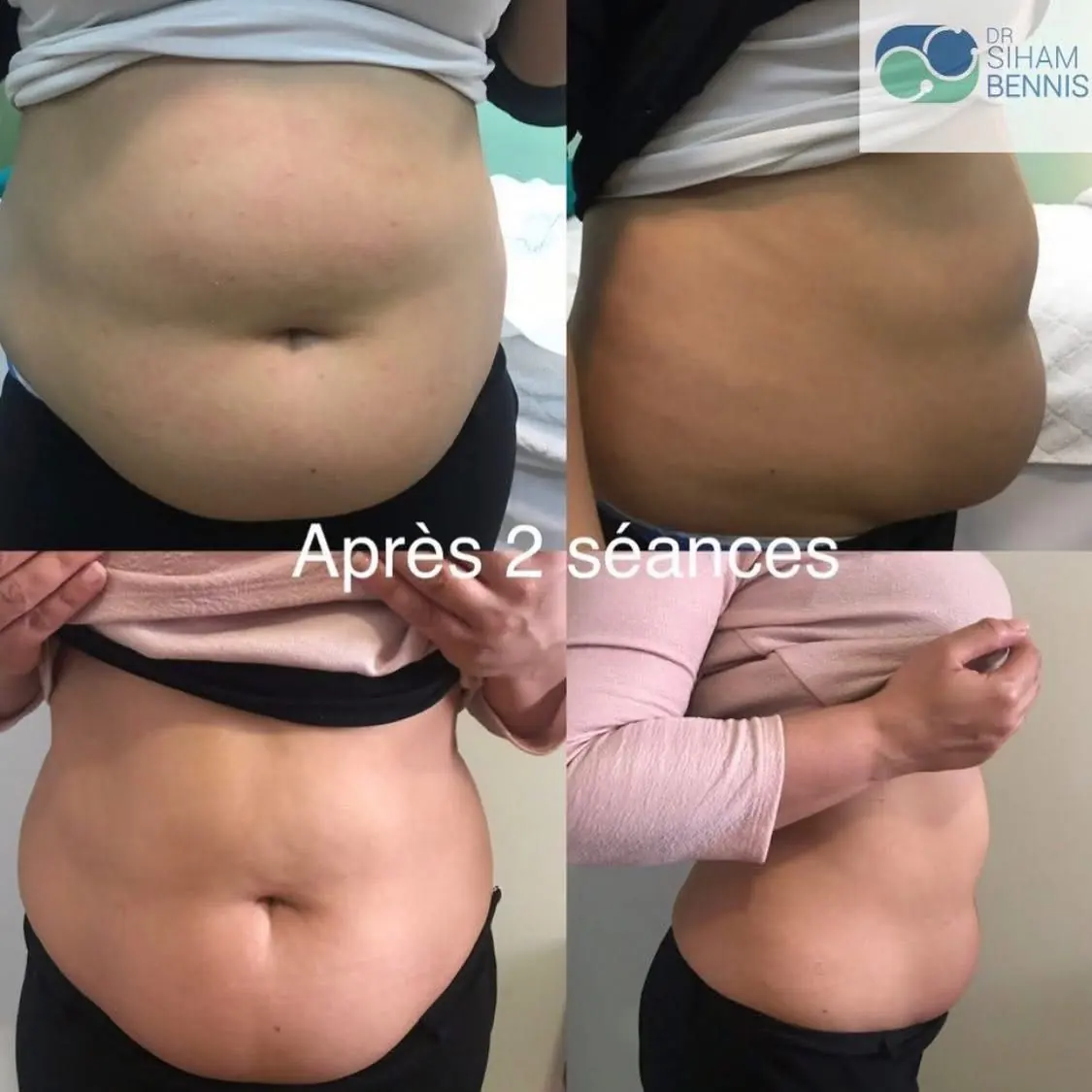 Avant / après cure minceur ventre après 2 séances