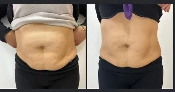 Résultat cure minceur ventre – Dr Siham Bennis Marrakech