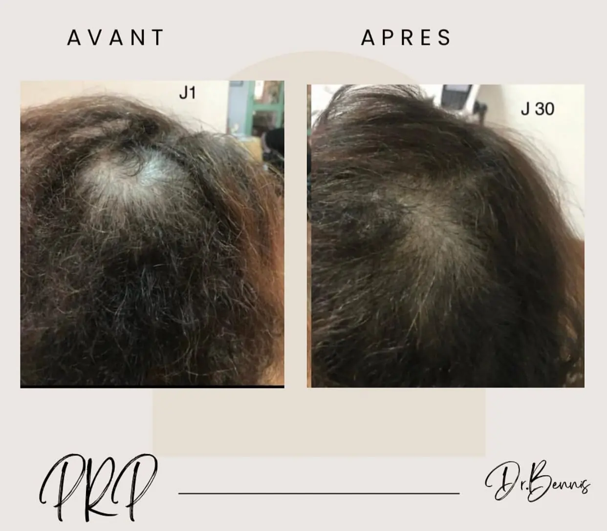 Avant / après PRP cheveux – Dr Siham Bennis Marrakech