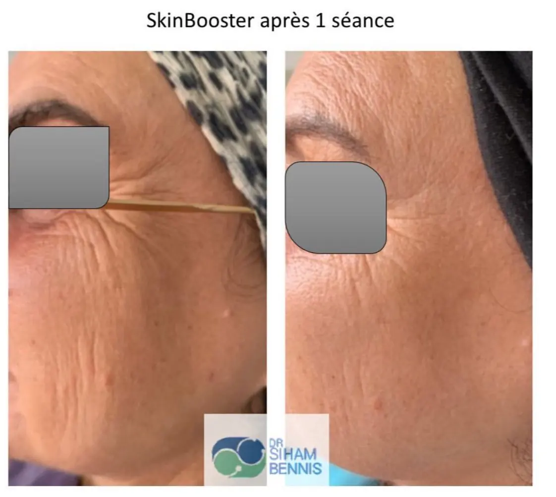 Avant / après Skinbooster, 1 séance – médecine esthétique Marrakech