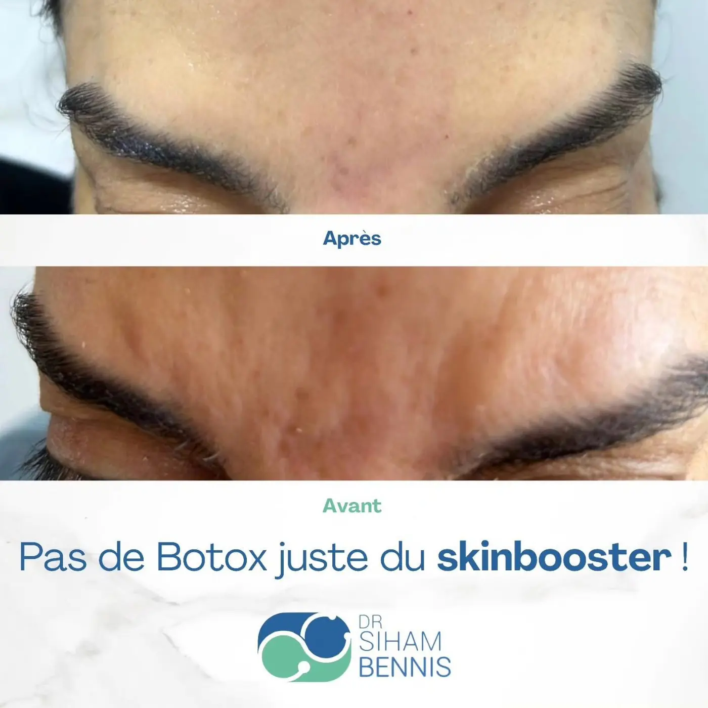 Avant / après Skinbooster sur les rides du front, sans Botox
